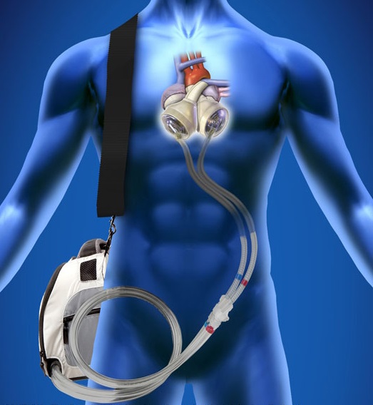 With an artificial heart system, there are two tubes that have to be connected to a machine to deliver compressed air into the ventricles, for blood to be pumped around the body. 