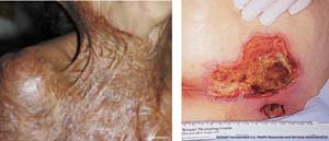 Fig. 3. Scar contraction after extensive burn with lack of subcutaneous fat tissue (left). Deep pressure ulcer (right). Picture: Strataderm (left); Hollister Incorporated /U.S. Health Resources and Services Administration (right)